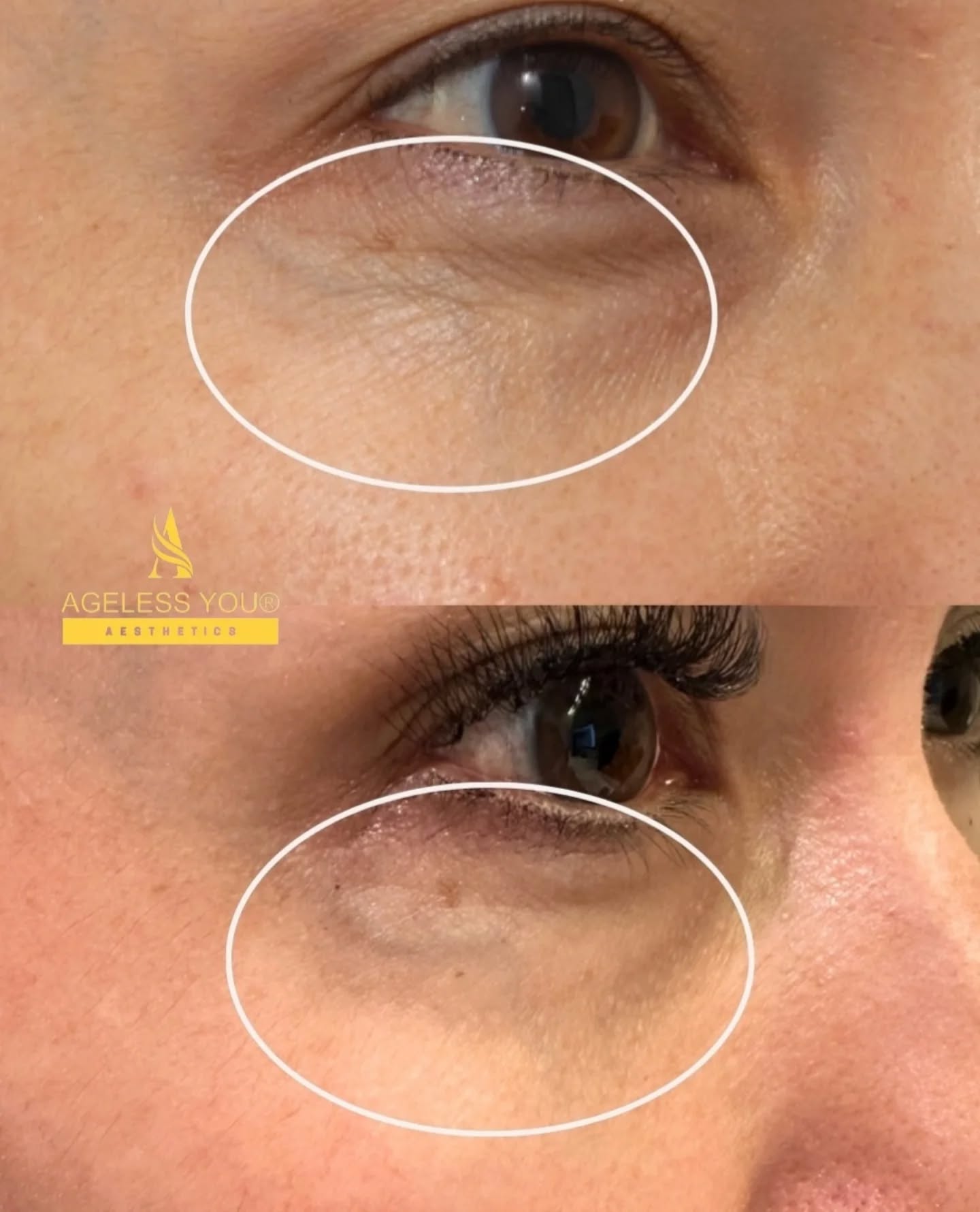 ✅️ Another happy client with visible results under the eyes!
Fresh, smoother, and brighter. Real improvements you can see after two Nucleofill Eyes treatments. We love helping our clients feel more confident and rejuvenated!
Nucleofill Eyes is designed to deeply hydrate, firm, and refresh the delicate under-eye area, reducing fine lines, dark circles, and puffiness naturally.
If you're looking for a subtle yet powerful boost, this could be the perfect treatment for you.
💌 DM us or send us a message on WhatsApp 07851 217 218 to book your appointment.
🌐 www.agelessyouaesthetics.co.uk
#BournemouthAesthetics #DorsetAesthetics #BournemouthSkinClinic #BournemouthBeautyClinic #PooleAesthetics #MobileAestheticsBournemouth #NucleofillEyes #UnderEyeGlow #BrightEyesBournemouth #SouthCoastAesthetics #BournemouthSelfCare #HealthcareLedAesthetics #GPhCRegistered #MedicallyTrainedInjector #SafeAestheticsUK #FullyInsuredClinic #UnderEyeTreatment #NucleofillBournemouth #YouthfulEyesBournemouth #DorsetSmallBusiness #SupportLocalDorset #NewBusinessUK #BeautyBusinessUK