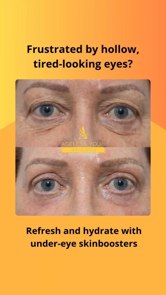 ✨ Under-eye bags, forehead lines, or neck wrinkles?
Turn back time and look younger with our Skin Boosters and Natural Wrinkle Treatments — for smooth, refreshed, and lifted skin.
✨ Under-eye Bags
If you’re struggling with dark circles or puffiness under the eyes, our Under-Eye Skin Boosters can help. Using a gentle injection of hyaluronic acid, we hydrate and restore volume, helping to reduce puffiness and brighten the area. The treatment is quick, non-invasive, and delivers noticeable results in just a few days.
💉 Forehead Lines
Forehead lines can become more prominent as we age, but with our Wrinkle Treatment, we can smooth out those lines with a precise, natural-looking result. Using advanced techniques, we inject a small amount of product into the lines, relaxing the muscles and giving you a youthful, refreshed look without looking overdone.
🌿 Neck Wrinkles
As we age, the skin on the neck can show signs of sagging and wrinkles. Our Neck Skin Boosters provide a lift and deep hydration. We use an injectable treatment that helps tighten and smooth the skin, giving you a firmer, more youthful neck. It’s a safe, non-surgical way to target this delicate area.
✅️ Non-invasive treatments with real, visible results. Book now!
📍 Serving Bournemouth & nearby areas
🚐 Mobile Clinic — We come to you!
🎓 Magdalena Ritchie, Advanced-Trained Healthcare Professional
💬 DM or WhatsApp for a FREE consultation: 07851 217 218
#BournemouthAesthetics #DorsetAesthetics #BournemouthSkinClinic #BournemouthBeautyClinic #PooleAesthetics #MobileAestheticsBournemouth #ProfhiloSkinbooster #GlowUp #SkinTransformation #FreshFace #YouthfulGlow #RadiantSkin #NaturalBeauty #SkincareBoost #HydrationBoost #MedicallyTrainedInjector #SafeAestheticsUK #FullyInsuredClinic #BeautyBusinessUK #BournemouthSelfCare #DorsetSmallBusiness #BournemouthBusiness #BournemouthLife #BournemouthClinics #BournemouthGlowUp #BournemouthMums #BournemouthWomen #BournemouthSkincare #AgelessYouAesthetics #BournemouthBeautyExperts