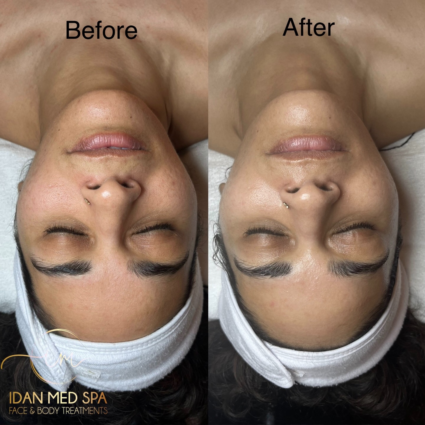 Glow from Within with Salmon DNA Facial
Experience the power of advanced skin rejuvenation with our Salmon DNA Facial.
This treatment helps to:
• Boost collagen and elasticity
• Deeply hydrate and repair the skin
• Improve texture, tone, and fine lines
• Reveal a natural, radiant glow
We combine nano-needling, microdermabrasion, LED therapy, and nourishing serums to deliver real results with no downtime.
Suitable for all skin types and anyone looking to refresh and restore their skin.
Book your appointment today and transform your skin.
#SalmonDNAFacial #SkinRejuvenation #GlowingSkin #FacialTreatment #MedSpaResults SkinCareGoals NanoNeedling HealthySkin GlowUp