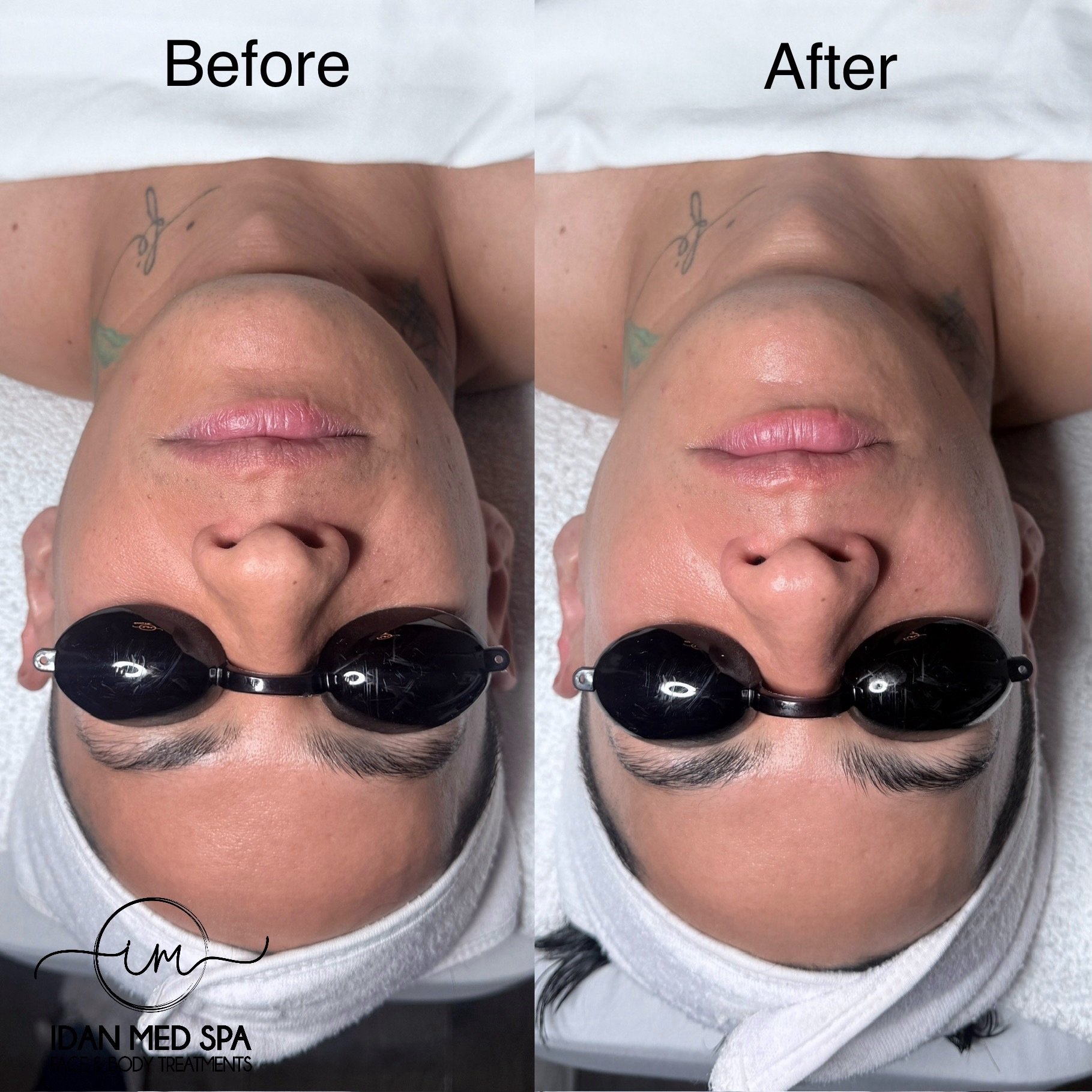 Salmon DNA Facial
Glow, smoother-looking texture, and refreshed skin after our Salmon DNA Facial with PDRN.
Needle-free • No downtime • Suitable for most skin types
New Client Special: $99
📍 Idan Med Spa — Encino & San Francisco
#SalmonDNAFacial #PDRNFacial #BeforeAndAfter #GlowingSkin SkinRejuvenation IdanMedSpa EncinoFacial SanFranciscoFacial