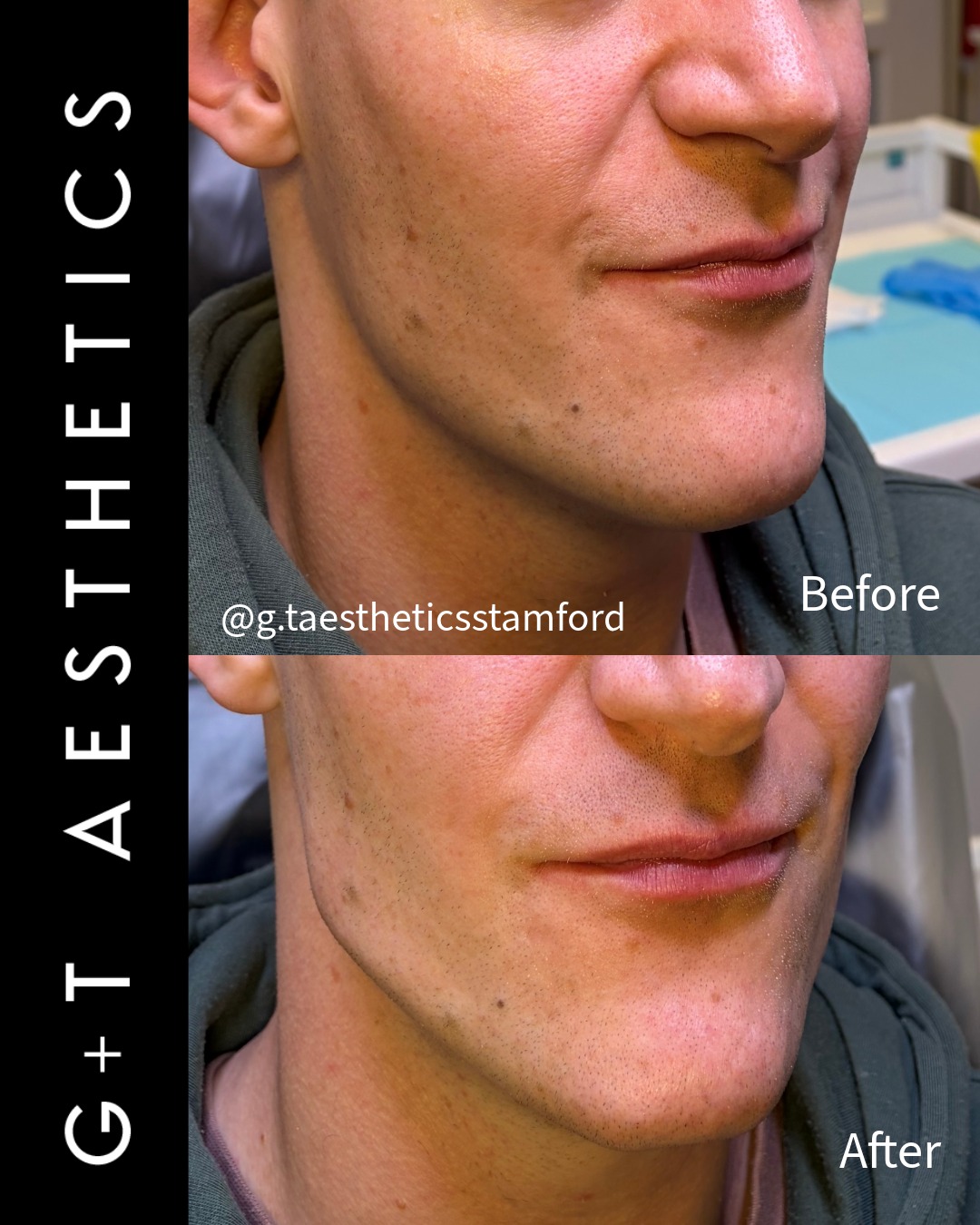 Strong features, refined precision. 🤝
Aesthetics isn’t one-size-fits-all, and male facial structure requires a completely distinct approach.
For this client, the goal was clear: build a sharper, more defined jawline and chin that naturally complements his masculine features. Using targeted dermal filler placement, we enhanced lower-face projection and structure while keeping the result completely seamless.
At G&T Aesthetics, every treatment plan is fully tailored to your unique proportions—giving you natural, noticeable results without looking "done."
📩 Thinking about refining your jawline? Book a private consultation via the link in our bio to discuss your personal goals.
📲Enquire or visit www.gtaesthetics.co.uk for more info.
#JawlineFiller #DermalFillers #FacialContouring #menshealth #aestheticsformen