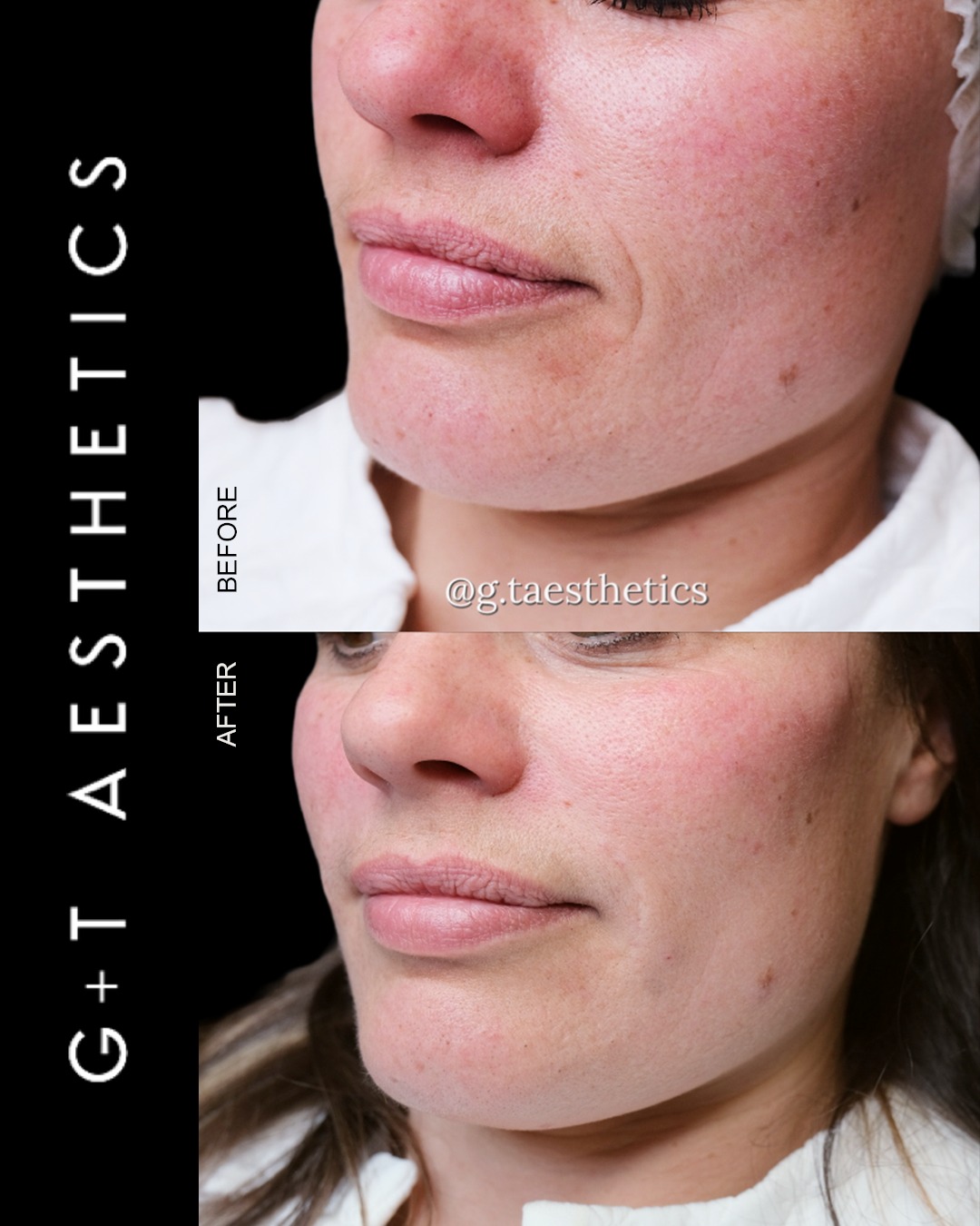 Marionette lines can become more pronounced over time, affecting the appearance and balance of the lower face.
This before-and-after shows how dermal fillers can restore support and soften the area's appearance, while keeping the overall result natural and proportionate.
Every treatment begins with an assessment to determine the most appropriate approach for the individual.
📲Enquire or visit www.gtaesthetics.co.uk for more info.
#GTAesthetics #MarionetteLines #DermalFillers #FacialAesthetics
