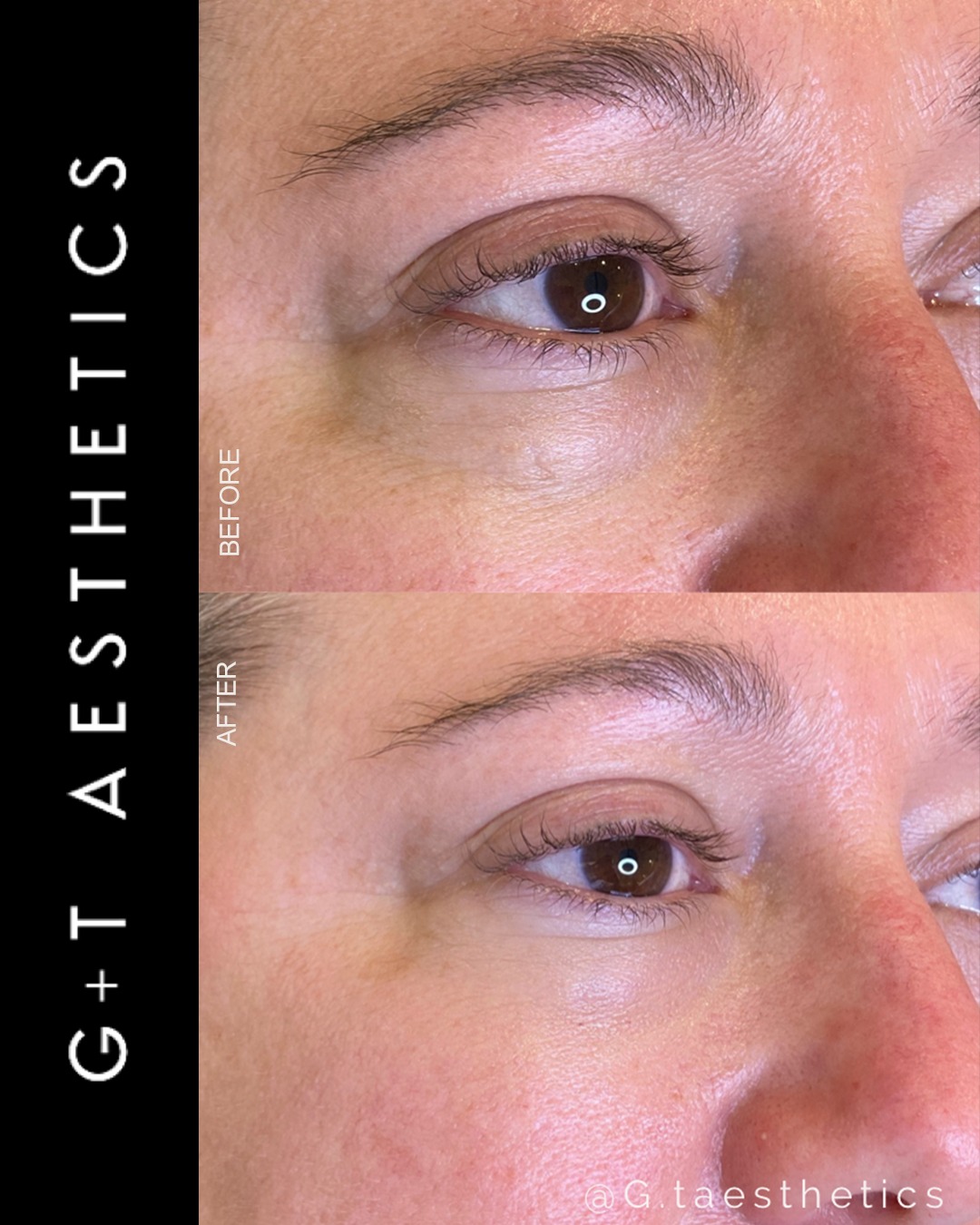 The under-eye area can influence how refreshed or tired the face appears.
This tear trough dermal filler before and after shows the result of treatment aimed at improving the appearance of under-eye hollowness and creating a more rested-looking appearance.
The tear trough is a delicate area, so careful assessment is essential to determine suitability and whether treatment is appropriate for the individual.
📲Enquire or visit www.gtaesthetics.co.uk for more info.
#GTAesthetics #TearTroughFiller #UnderEyeFiller #DermalFillers